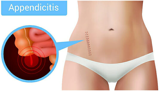 What Food Can Cause Appendicitis