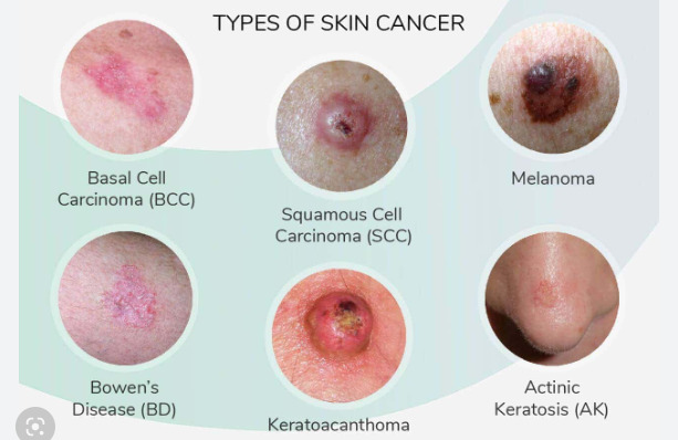 Symptoms Of Skin cancer