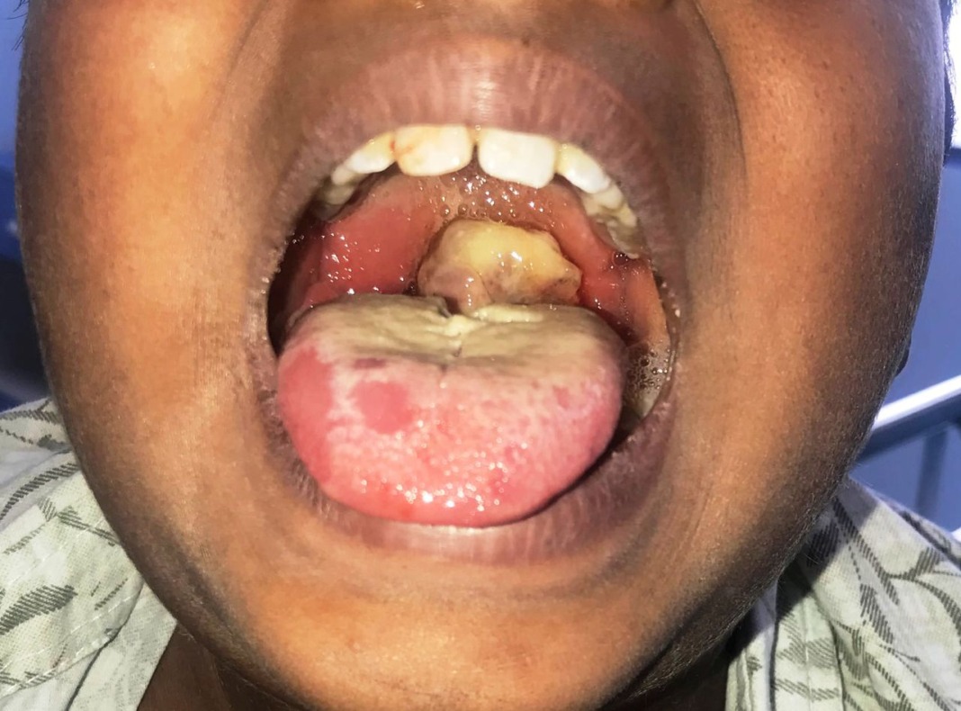 Diphtheria patient
