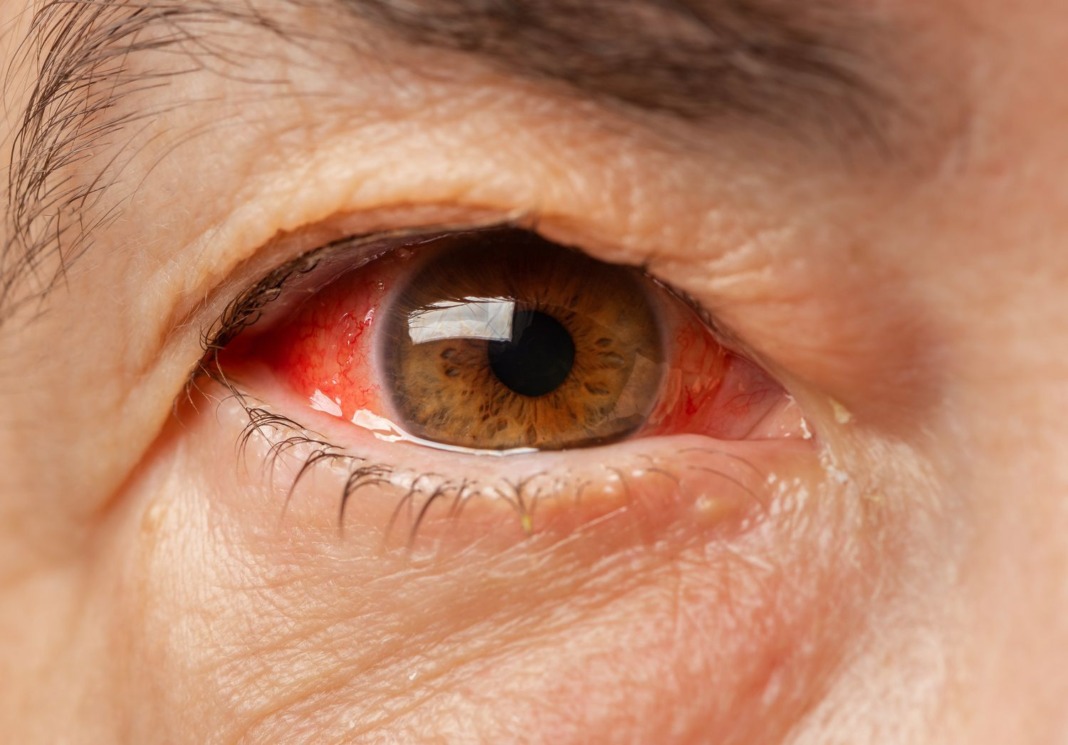 Causes of Pink Eye in Adults