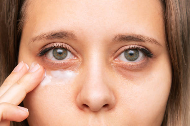 How To Get Rid of Eye Bags
