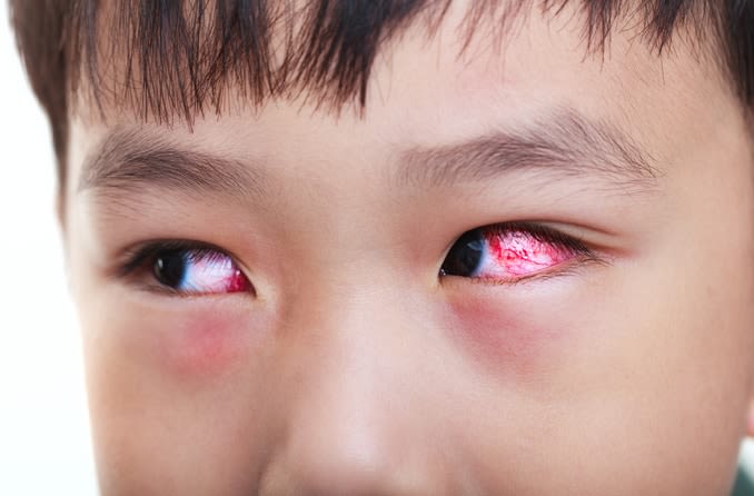 Causes of Pink Eye in Adults