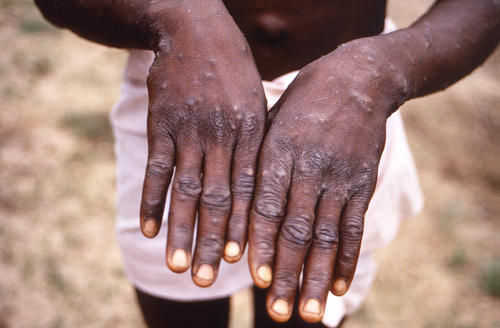 CDC Warns of Highly Contagious Clade I Monkeypox Strain