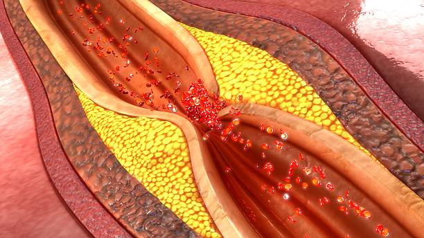 Causes of Blocked Arteries