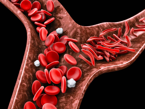 How to Clear Blocked Arteries Without Surgery