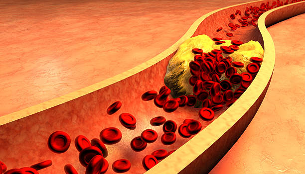 Warning Signs of Clogged Arteries