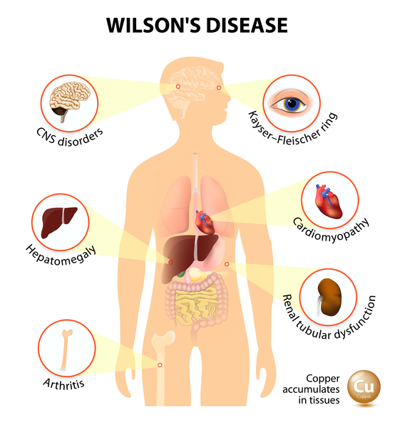Wilson’s Disease