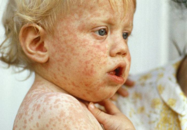 Fear of Measles outbreak in Canada