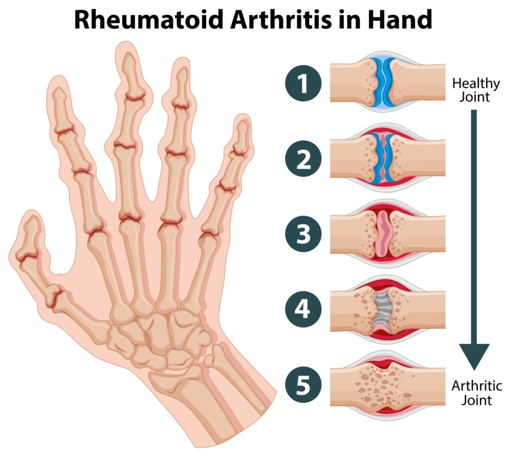 How To Test For Rheumatoid Arthritis