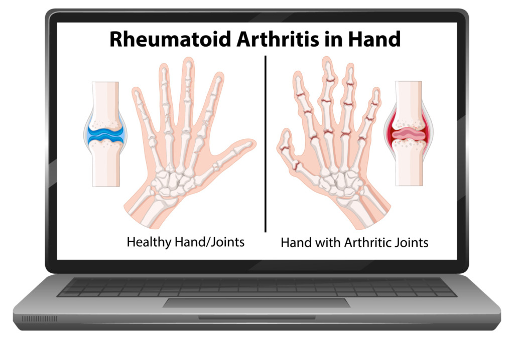 How To Test For Rheumatoid Arthritis