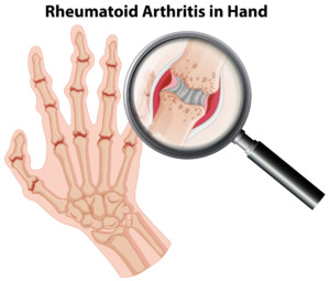 How To Get Rid Of Arthritis In Fingers
