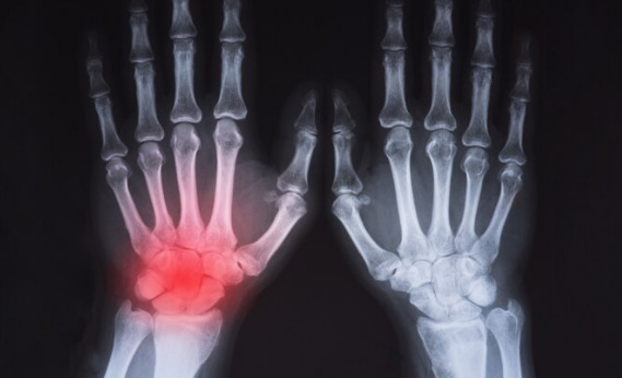 How To Cure Rheumatoid Arthritis Permanently