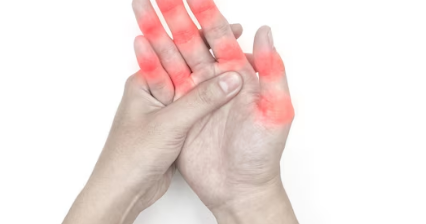 How To Cure Rheumatoid Arthritis Permanently