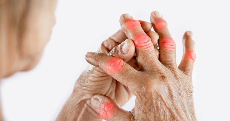 How To Get Rid Of Arthritis In Fingers
